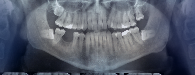 Radiografia odontológica com IA pode ampliar produtividade profissional